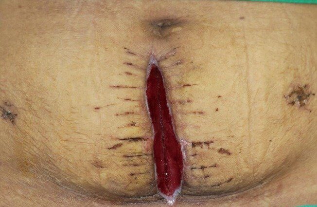 Postoperative Wound Management