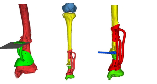 Innovative Uses of 3D Printing in Trauma Orthopedic Surgery