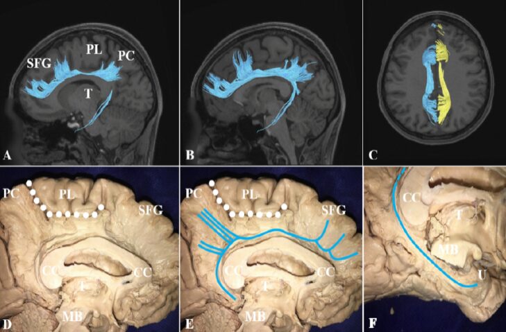 Study of the Superior Frontal Gyrus and Its White Matter Connections
