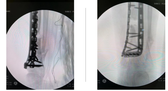 Innovative Uses of 3D Printing in Trauma Orthopedic Surgery