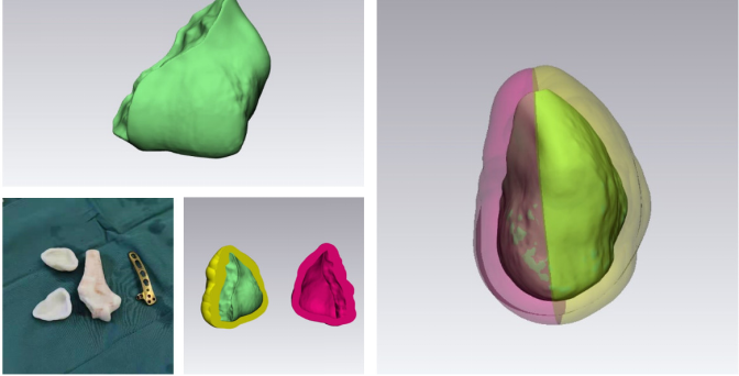 Innovative Uses of 3D Printing in Trauma Orthopedic Surgery