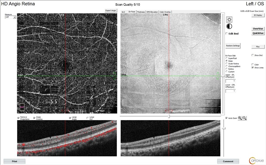 Professor Chen Juan: A Case of Unusual Pediatric Macular Degeneration