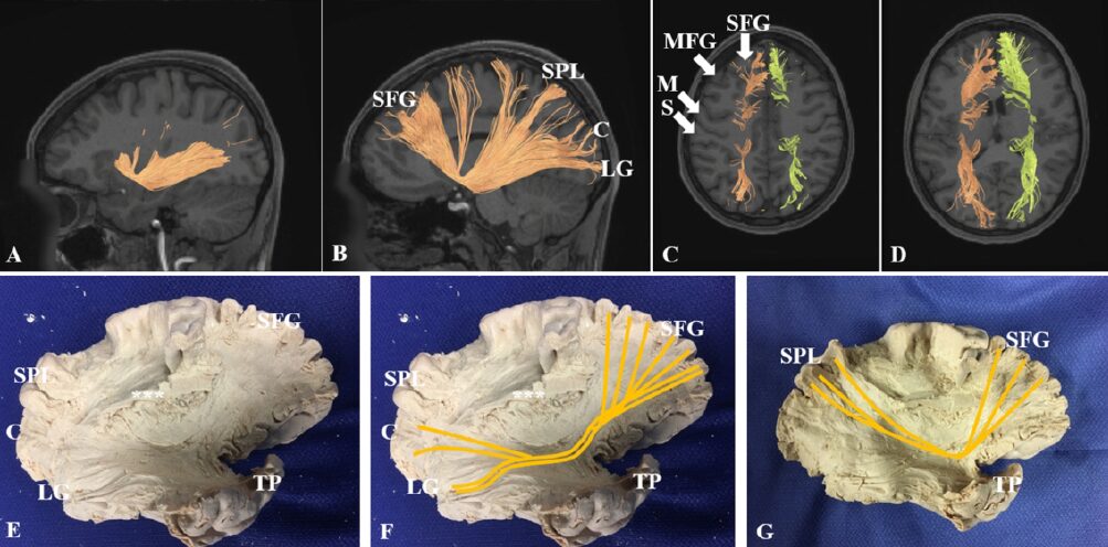 Study of the Superior Frontal Gyrus and Its White Matter Connections