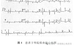 Competition Between Intrinsic Rhythm and Pacemaker Rhythm Leading to Misdiagnosis of Pacemaker Dysfunction