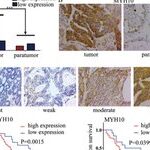 New Predictive Factors for Poor Prognosis in SOC