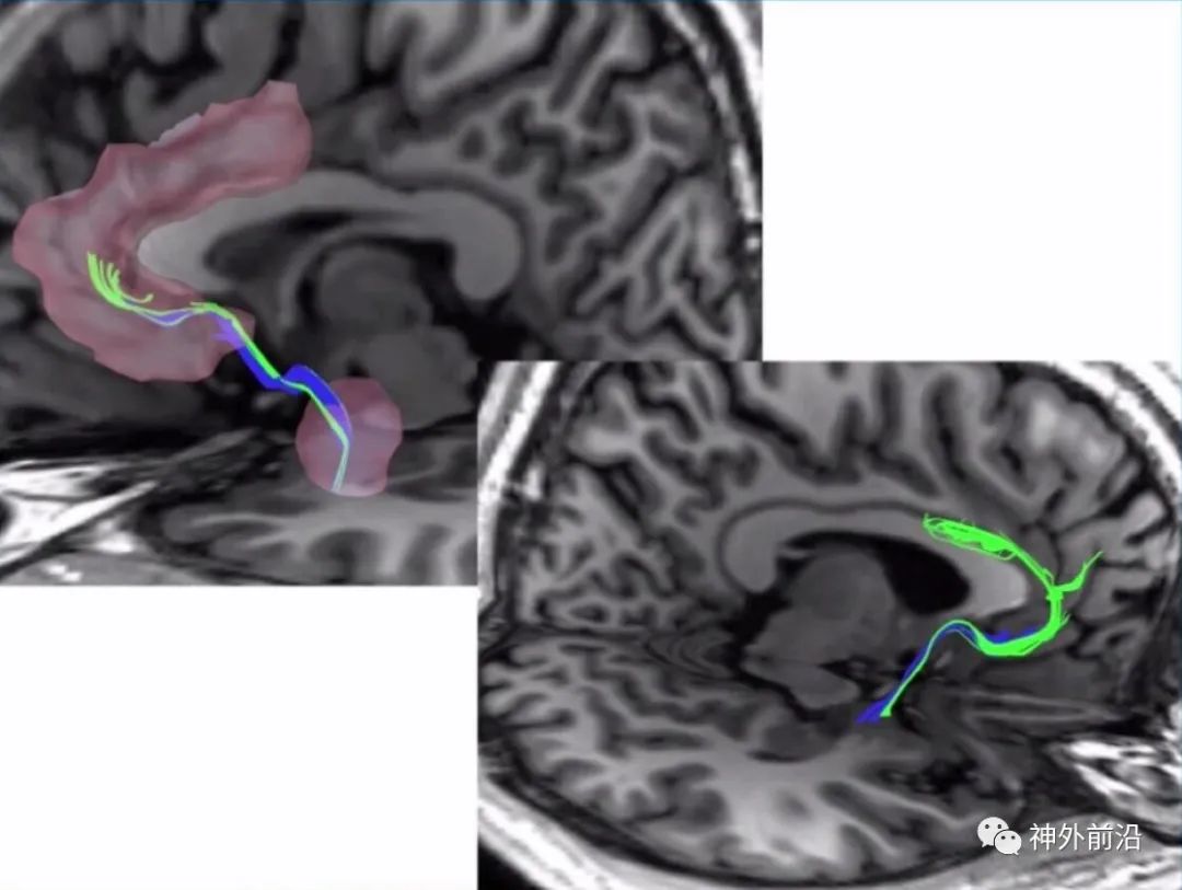 Cingulate Cortex Epilepsy and Surgical Treatment