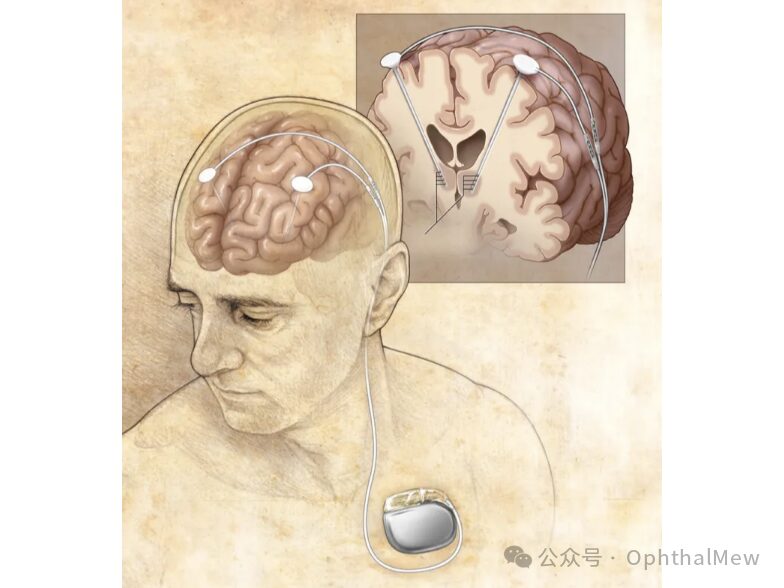 Understanding Eyelid Spasms and Their Treatment
