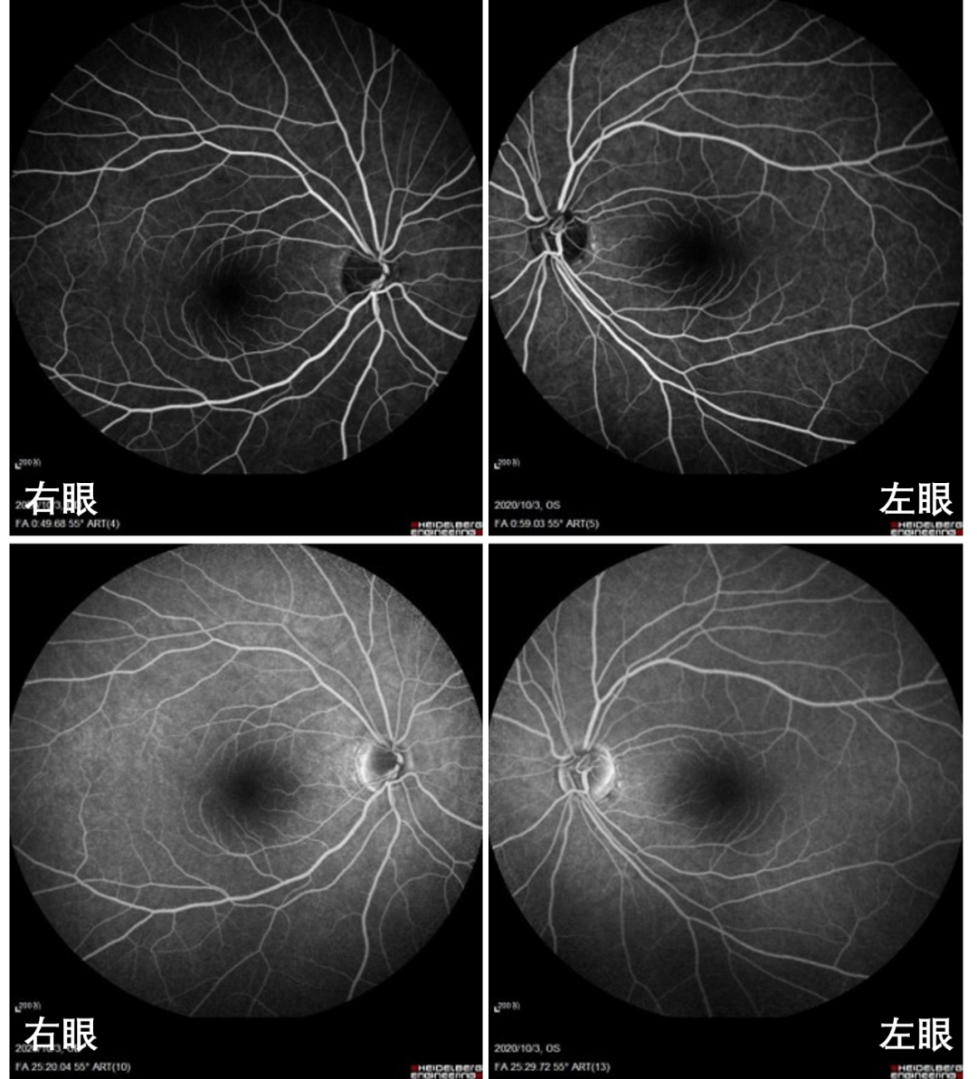 Professor Chen Juan: A Case of Unusual Pediatric Macular Degeneration