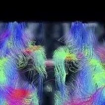 Study of the Superior Frontal Gyrus and Its White Matter Connections