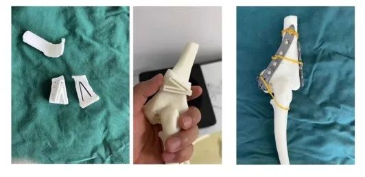 Innovative Uses of 3D Printing in Trauma Orthopedic Surgery