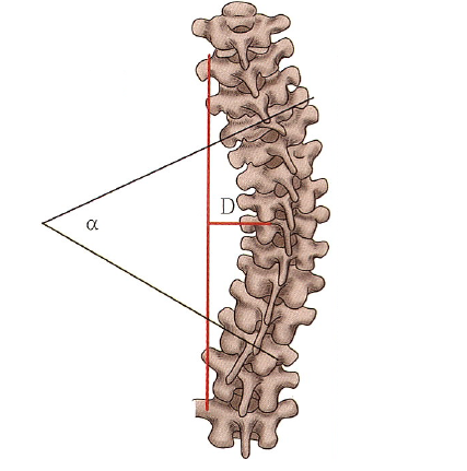 Biomechanics of Spinal Deformities