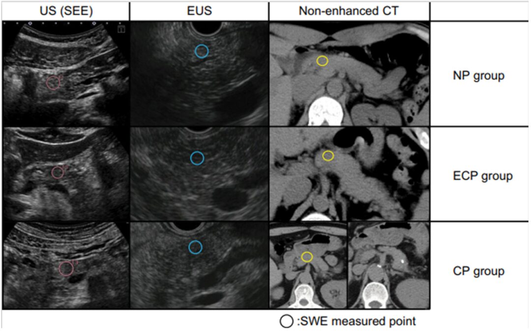 The Role of Shear Wave Elastography in Diagnosing Chronic Pancreatitis