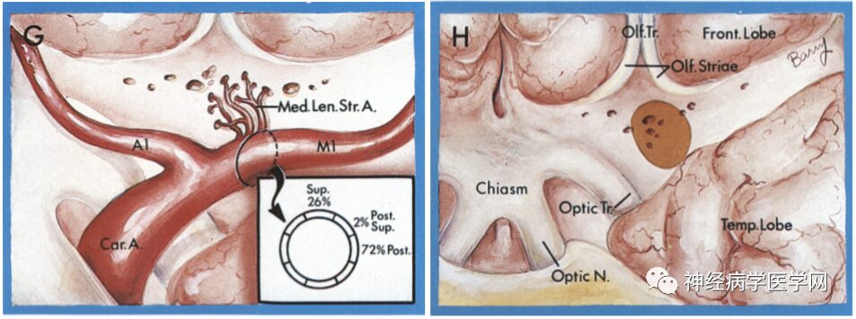 Types of Infarction in Perforating Artery Disease and Advances in Neuroimaging Research