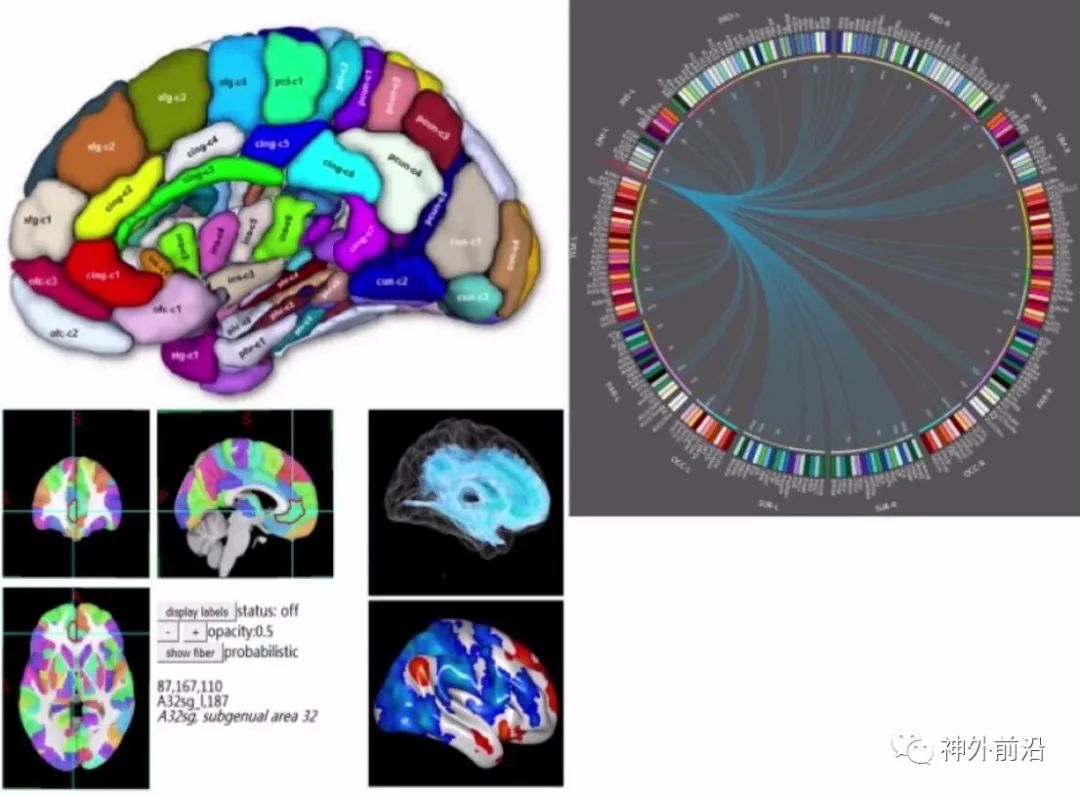 Cingulate Cortex Epilepsy and Surgical Treatment
