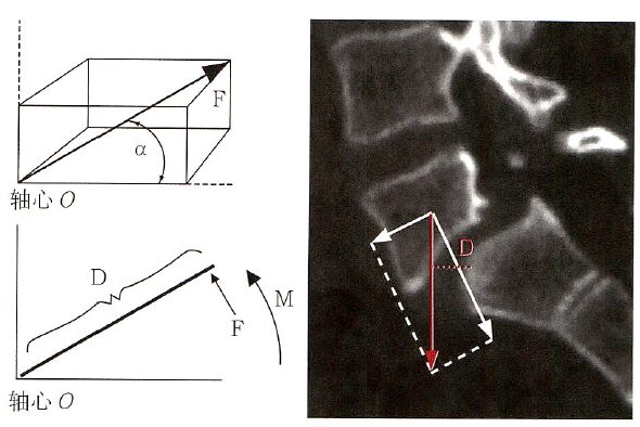 Biomechanics of Spinal Deformities