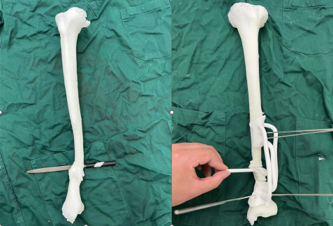 Innovative Uses of 3D Printing in Trauma Orthopedic Surgery