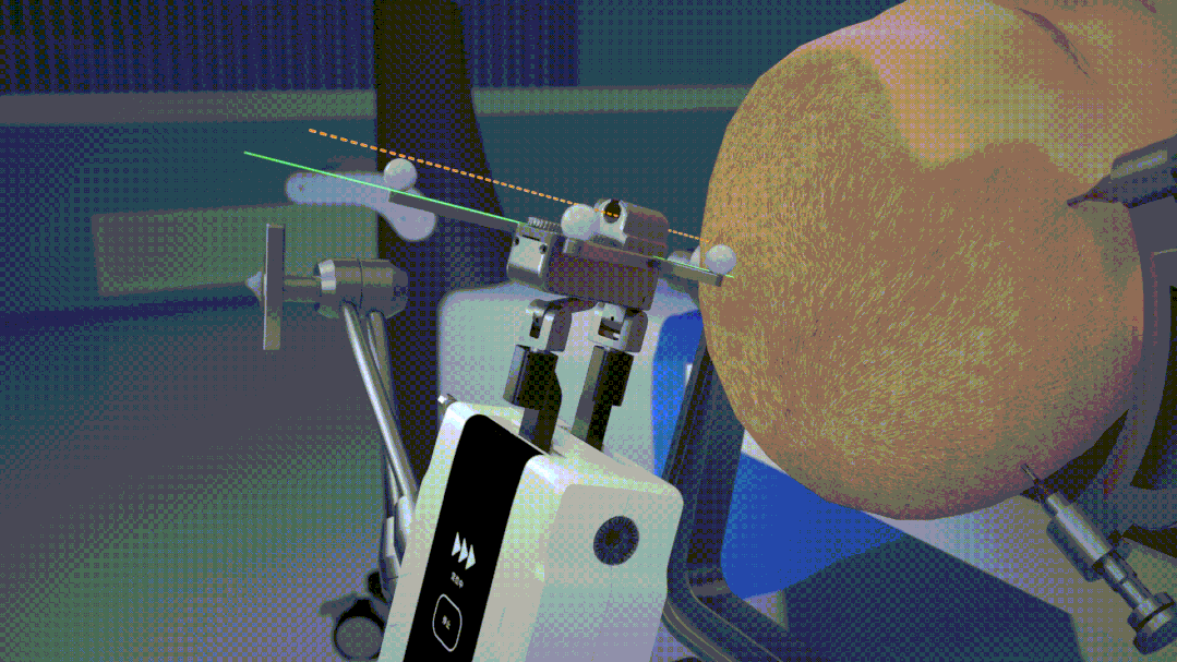 Video Demonstration: Principles and Steps of Q300 Micro Robot-Assisted Hemorrhagic Stroke Puncture Surgery