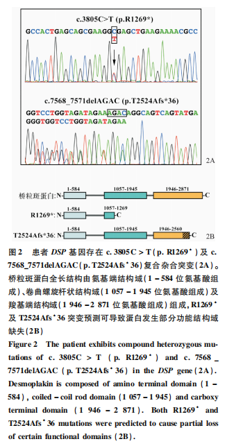 Case Report on Skin Fragility and Woolly Hair Syndrome Due to DSP Gene Mutation