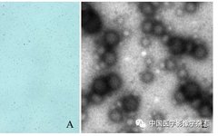 Inhibition of Breast Cancer Cells by Novel Nanoparticles Combined with Low-Intensity Focused Ultrasound