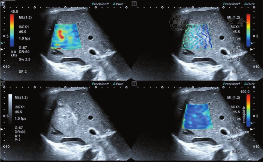 Preliminary Application of Shear Wave Dispersion Imaging in Differentiating Benign and Malignant Liver Tumors