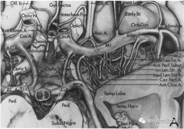 Types of Infarction in Perforating Artery Disease and Advances in Neuroimaging Research