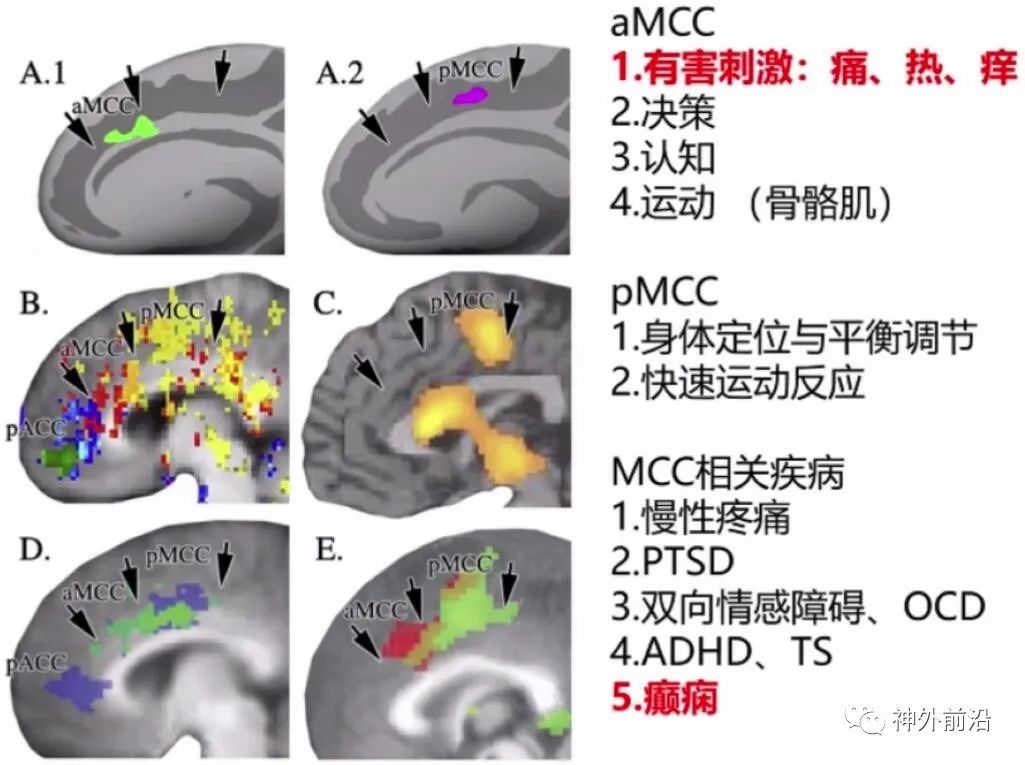 Cingulate Cortex Epilepsy and Surgical Treatment