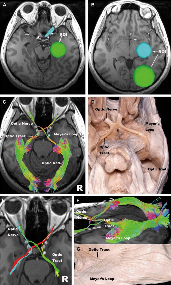 The Anatomical Significance of Brain White Matter Tracts