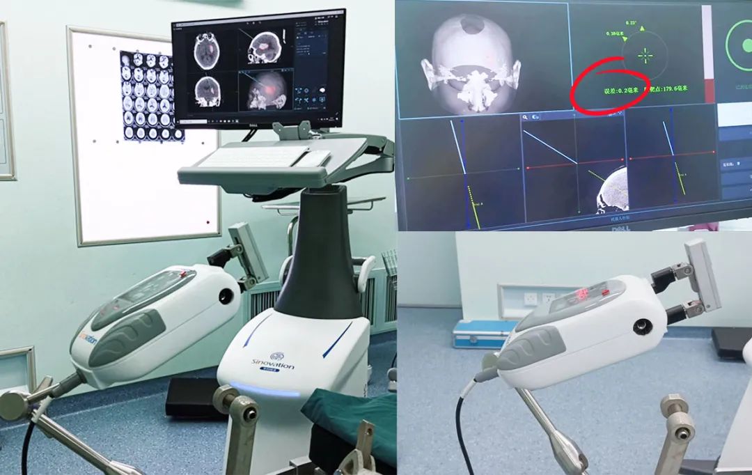 Precision Treatment: Micro-Robots Revolutionizing Neurosurgery