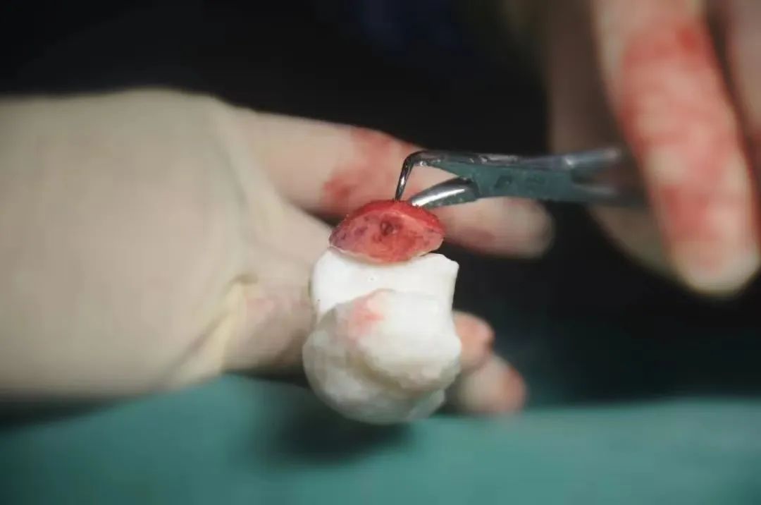 3D Printing Technology for Precise Treatment of Severe Fractures
