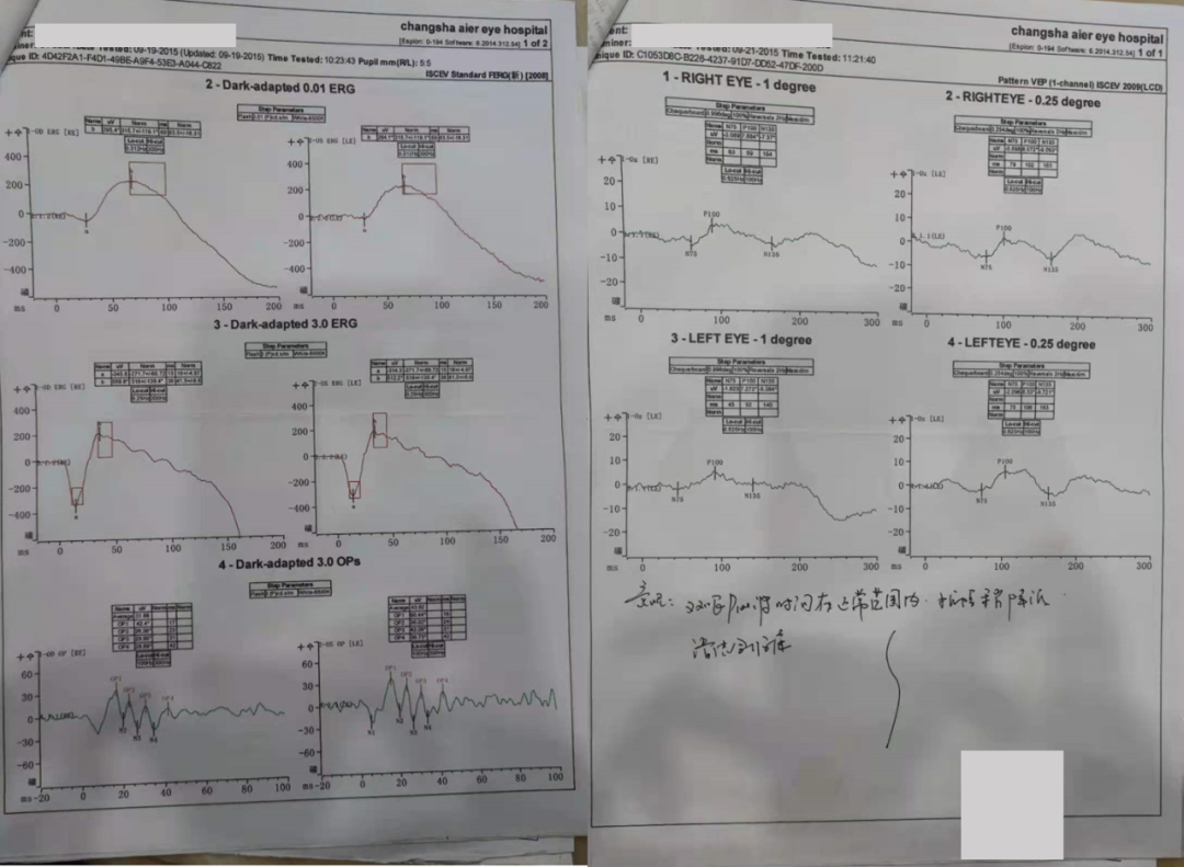 Professor Chen Juan: A Case of Unusual Pediatric Macular Degeneration