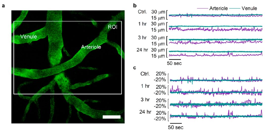 Laser and Gold Nanoparticles: Breaking the Blood-Brain Barrier for Faster Drug Delivery
