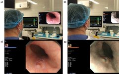 Evaluation of AI-Assisted Early Esophageal Squamous Cell Carcinoma Diagnosis
