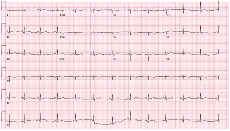 Desmoplakin Cardiomyopathy Mimicking Viral Myocarditis