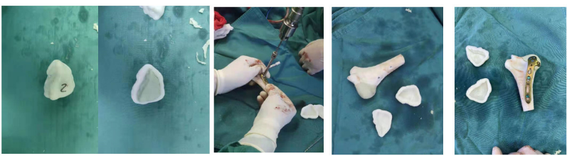 Innovative Uses of 3D Printing in Trauma Orthopedic Surgery