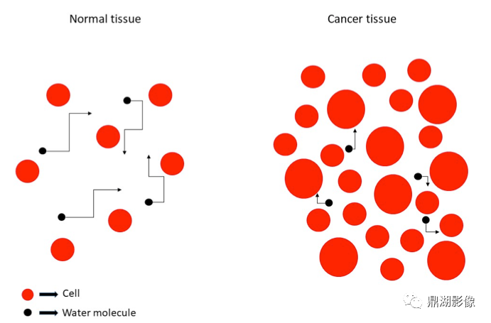 Principles and Clinical Applications of Diffusion Weighted Imaging (DWI and ADC)