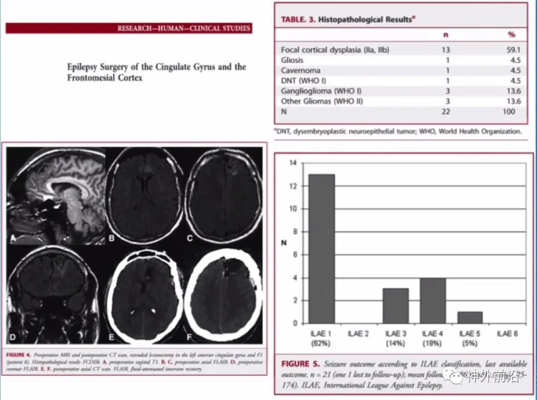 Cingulate Cortex Epilepsy and Surgical Treatment