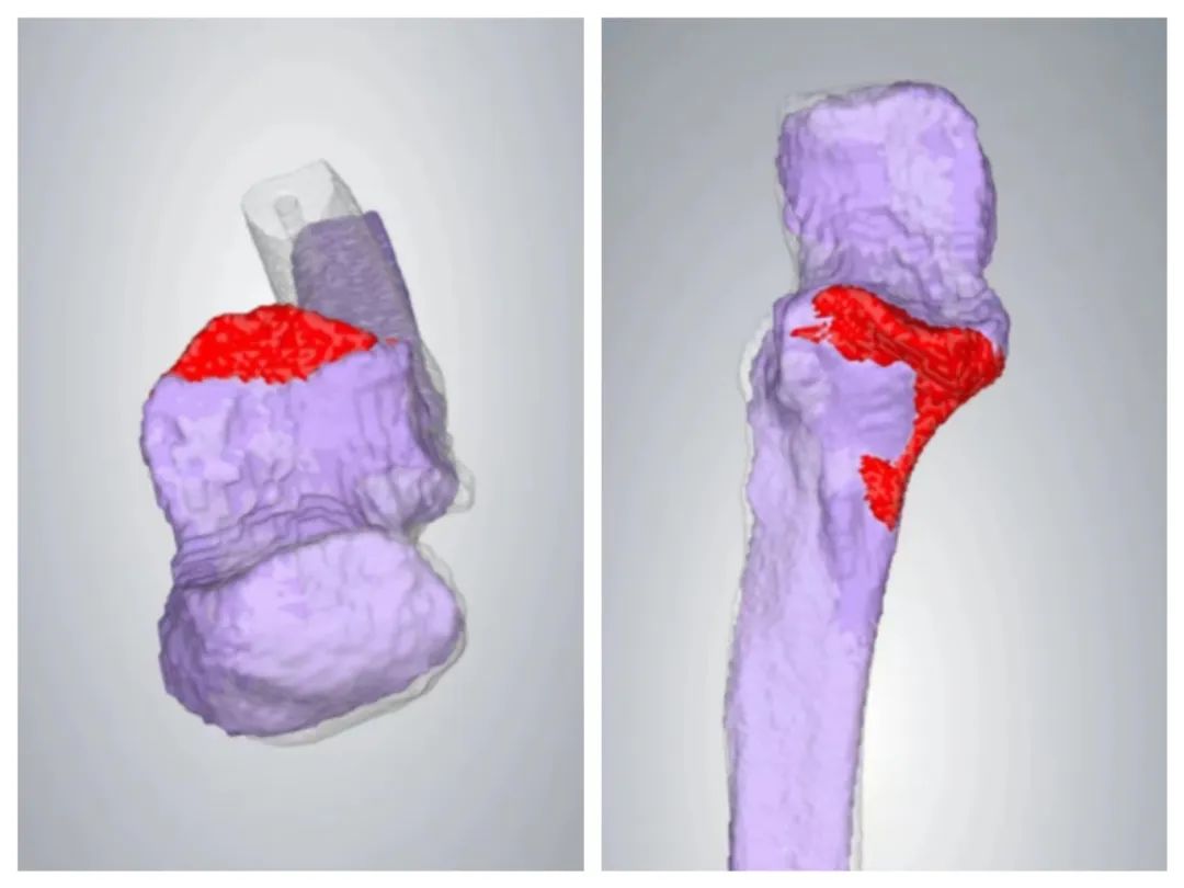 3D Printing Technology for Precise Treatment of Severe Fractures