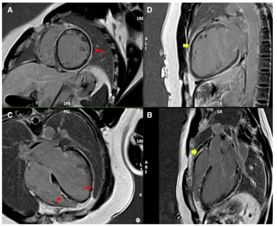 Desmoplakin Cardiomyopathy Mimicking Viral Myocarditis