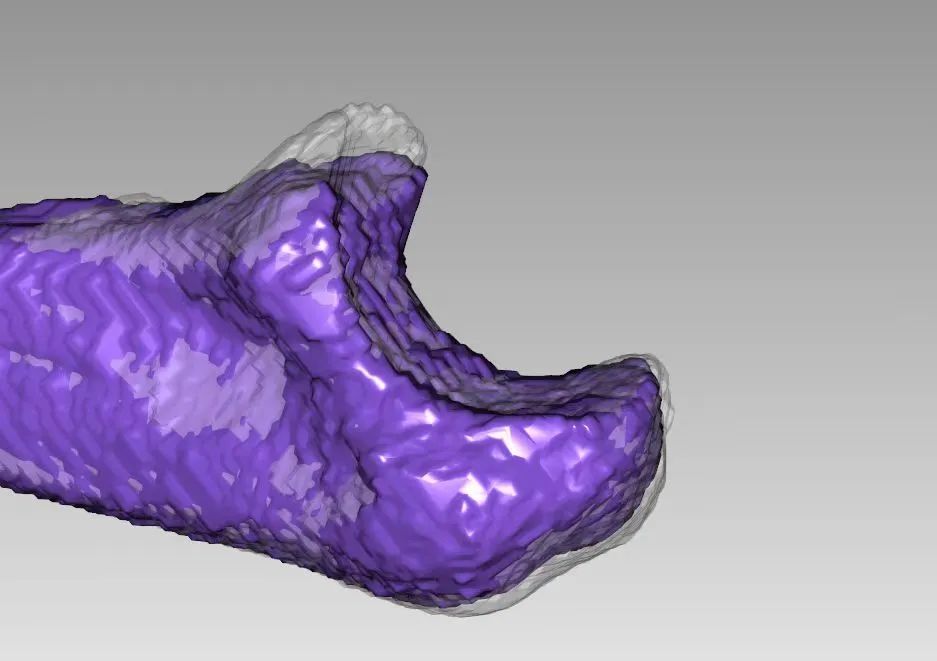 3D Printing Technology for Precise Treatment of Severe Fractures