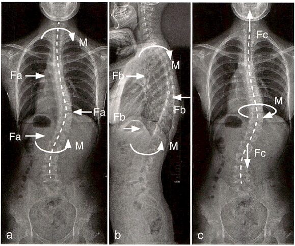 Biomechanics of Spinal Deformities