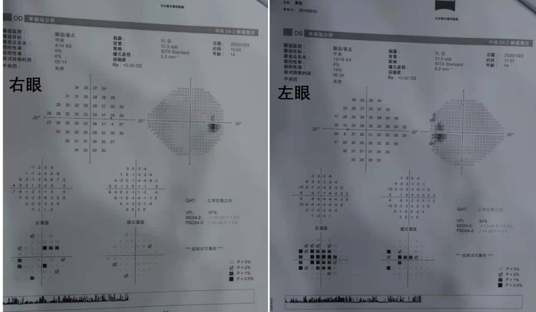 Professor Chen Juan: A Case of Unusual Pediatric Macular Degeneration
