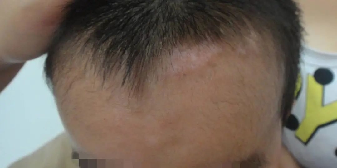 What to Consider for Children with Vitiligo Undergoing SWD Skin Grafting in Switzerland