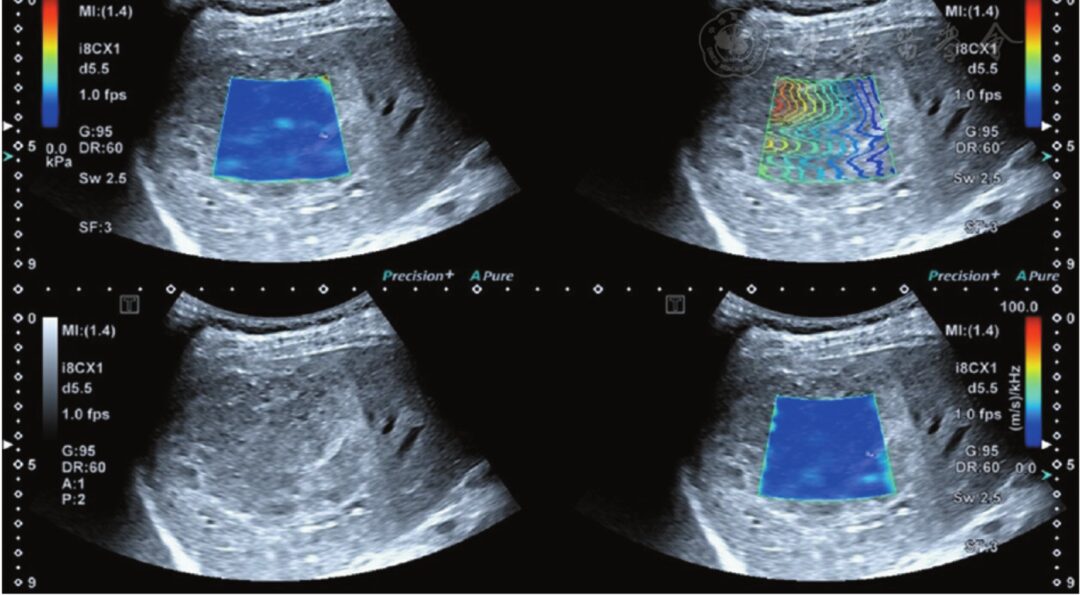 Preliminary Application of Shear Wave Dispersion Imaging in Differentiating Benign and Malignant Liver Tumors