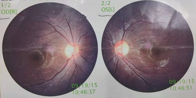 Professor Chen Juan: A Case of Unusual Pediatric Macular Degeneration