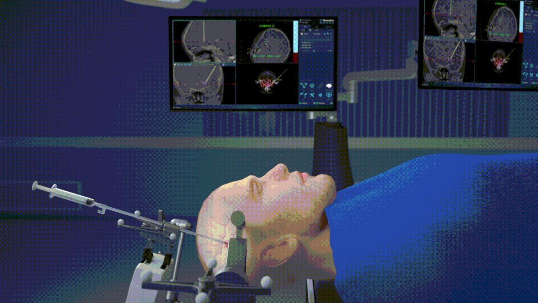Video Demonstration: Principles and Steps of Q300 Micro Robot-Assisted Hemorrhagic Stroke Puncture Surgery
