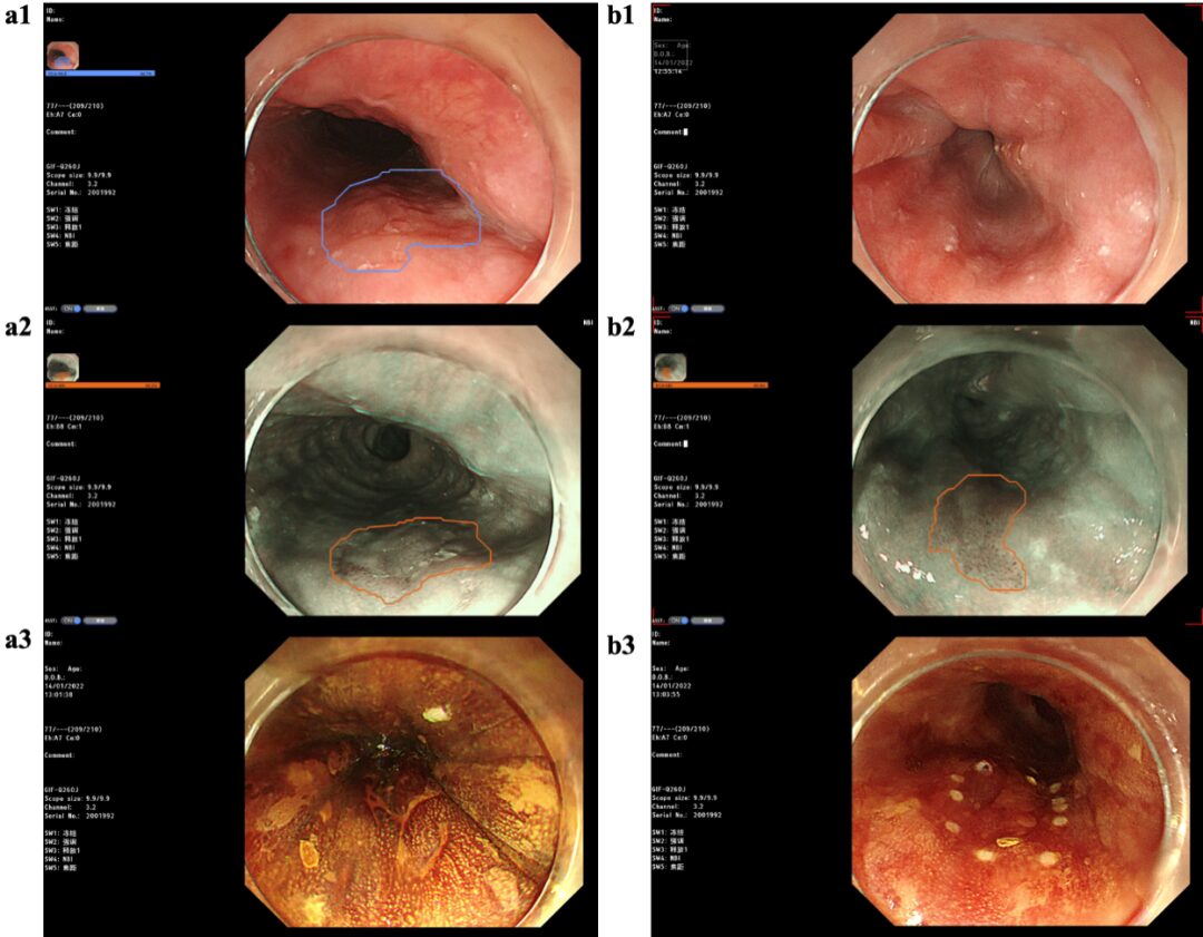 Evaluation of AI-Assisted Early Esophageal Squamous Cell Carcinoma Diagnosis