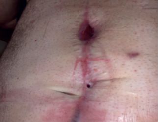 Identification, Assessment, and Classification of Postoperative Wound Dehiscence