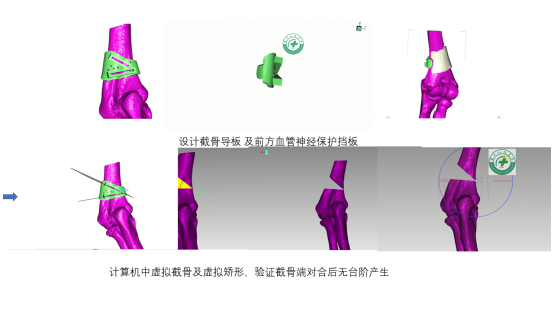 Innovative Uses of 3D Printing in Trauma Orthopedic Surgery