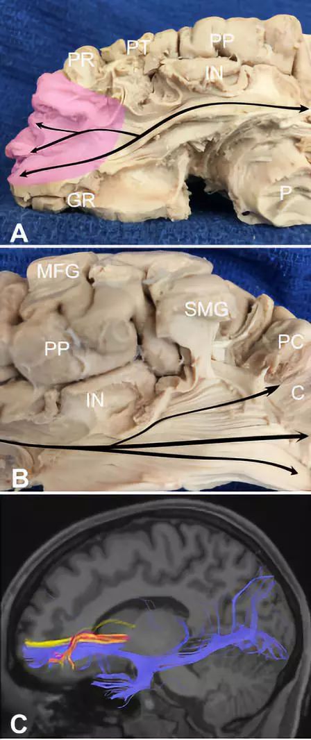 The Anatomical Significance of Brain White Matter Tracts