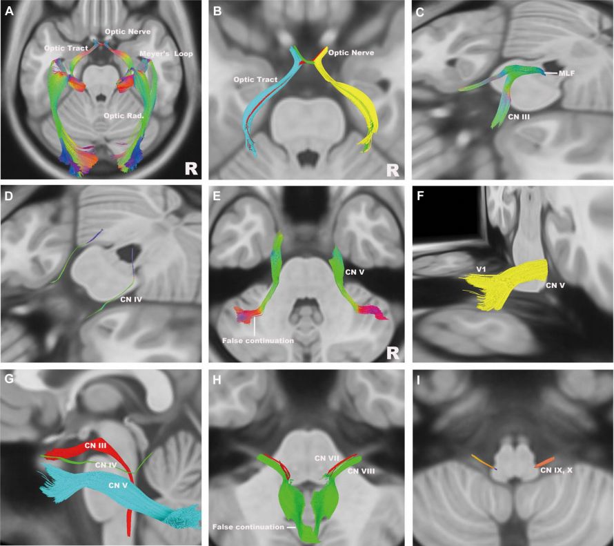 The Anatomical Significance of Brain White Matter Tracts